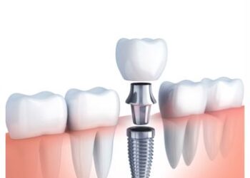 Pavienio danties implantacija
