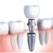 Pavienio danties implantacija
