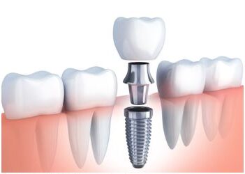 Pavienio danties implantacija